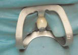 Зуб 12 изолирован с помощью резиновой завесы и кламмера приспособления «Коффердам»