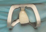 Построение вестибулярной поверхности зуба 12 эмалевым оттенком В3