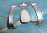 Наложение прозрачного оттенка желтая эмаль (YE) по телу и режущему краю зуба