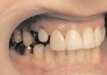 Внешний вид зуба 12 после полировки