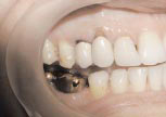 Исходная ситуация: на зубах 14, 13, 123 стоят металлокерамические коронки требующие замены
